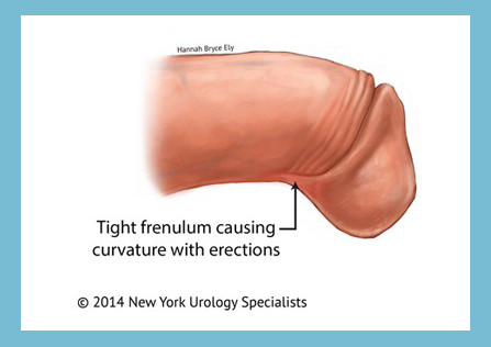 Penile frenulectomy for curve